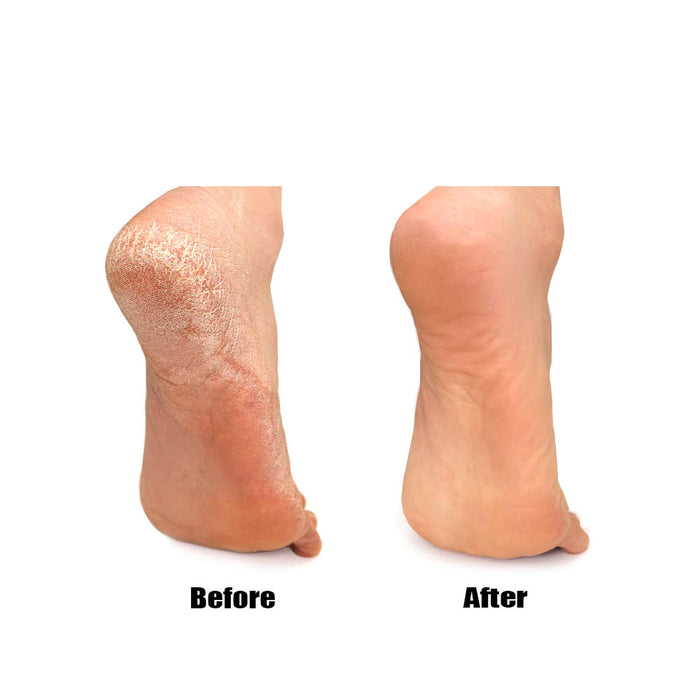 3 Pc Pedicure Callous Callus Shaver Foot Care Hard Tough Skin Corn